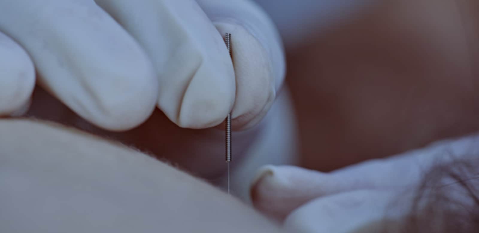 Needling Therapy